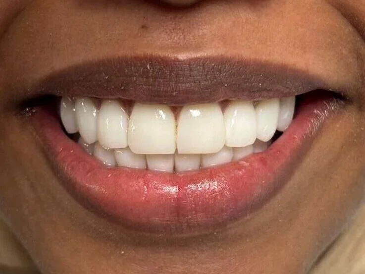 Composite bonding after photo, upper front teeth, case 1