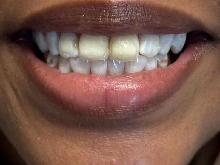 Composite bonding before photo, upper front teeth, case 1
