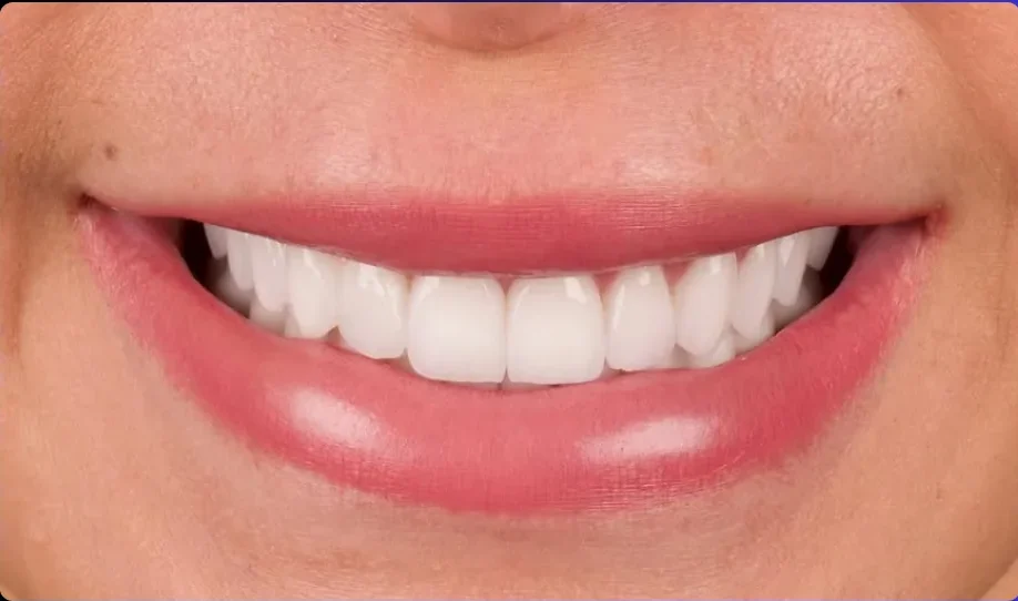 Composite bonding after photo, upper front teeth, case 8