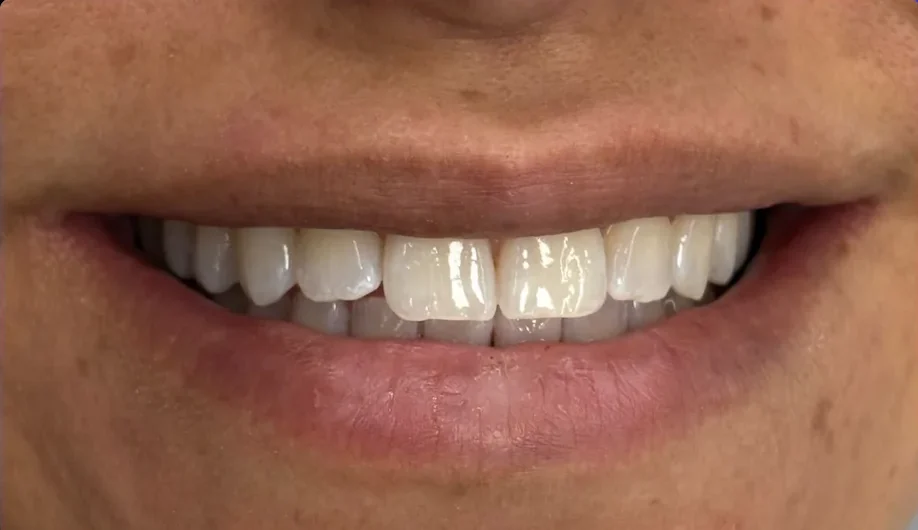 Composite bonding before photo, upper front teeth, case 9