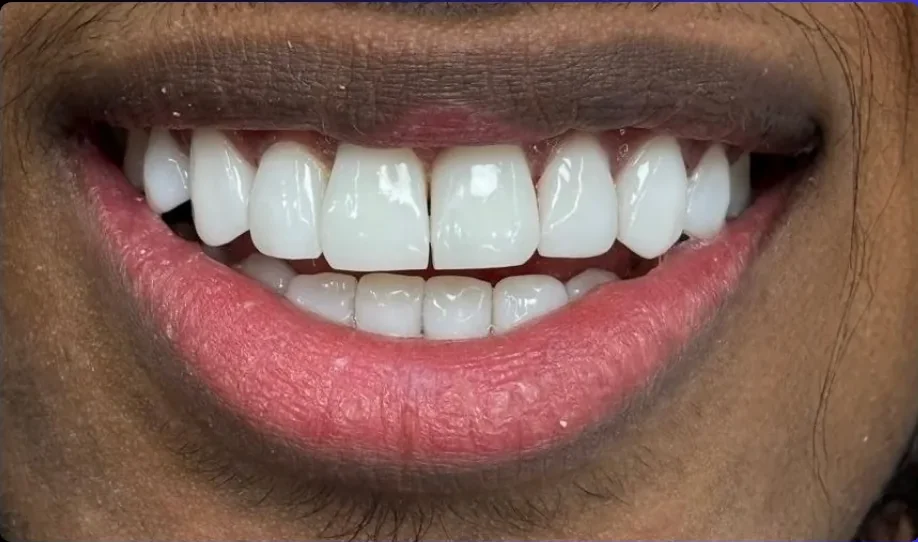 Composite bonding after photo, upper front teeth, case 10