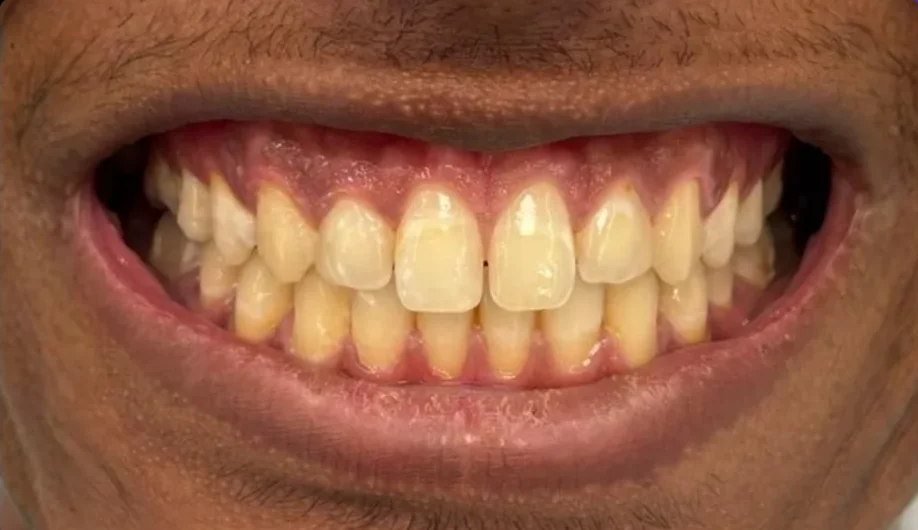 Composite bonding before photo, upper front teeth, case 10