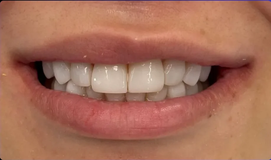 Composite bonding after photo, upper front teeth, case 11