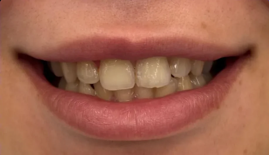 Composite bonding before photo, upper front teeth, case 11
