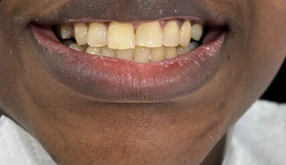 Composite bonding before photo, upper front teeth, case 12