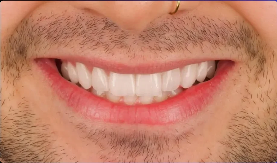 Composite bonding after photo, upper front teeth, case 13