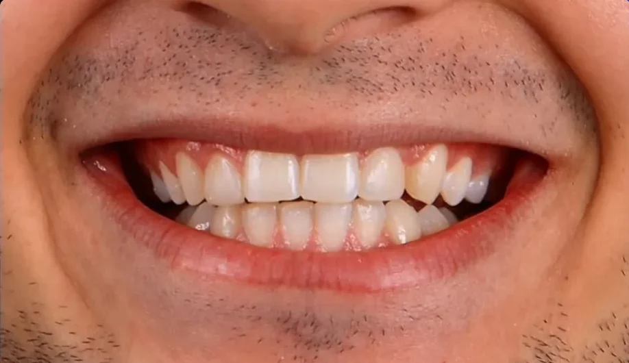 Composite bonding before photo, upper front teeth, case 13