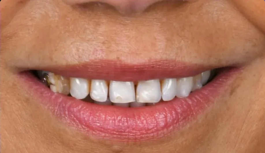Composite bonding before photo, upper front teeth, case 14