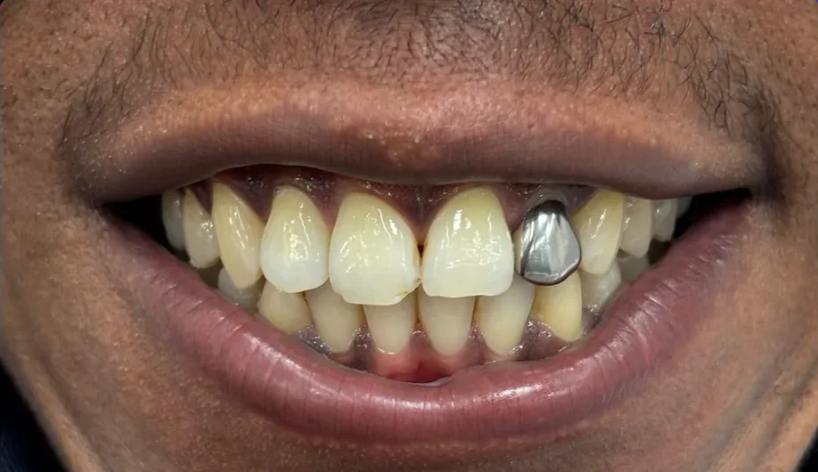 Composite bonding before photo, upper front teeth, case 15