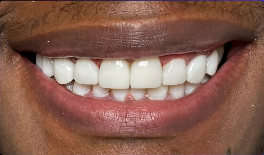 Composite bonding after photo, upper front teeth, case 16