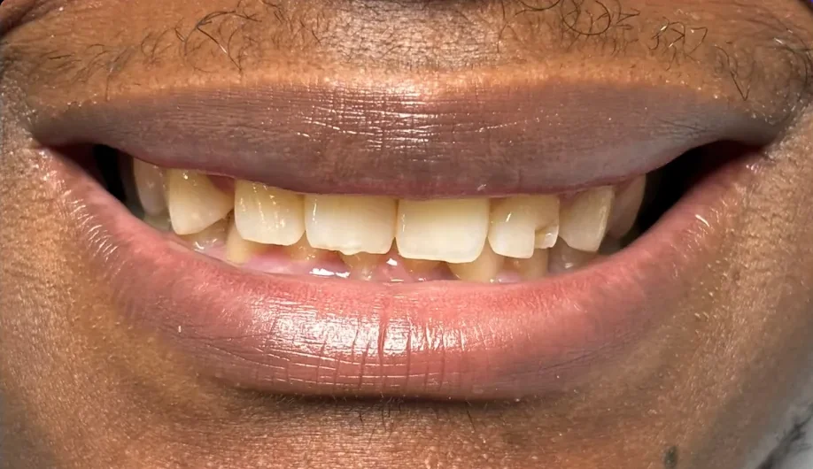 Composite bonding before photo, upper front teeth, case 16
