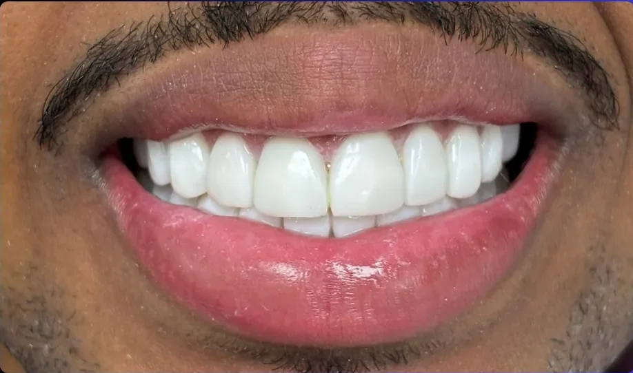 Composite bonding after photo, upper front teeth, case 17