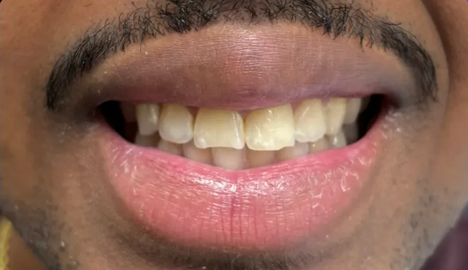 Composite bonding before photo, upper front teeth, case 17