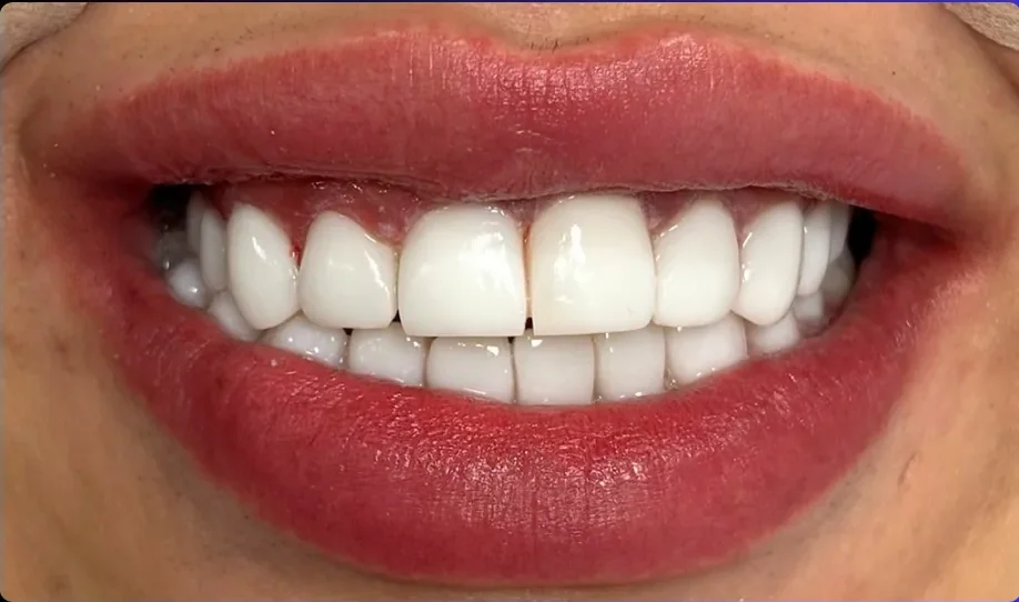 Composite bonding after photo, upper front teeth, case 19