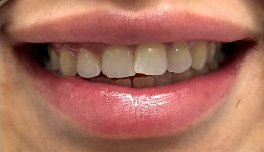Composite bonding before photo, upper front teeth, case 19