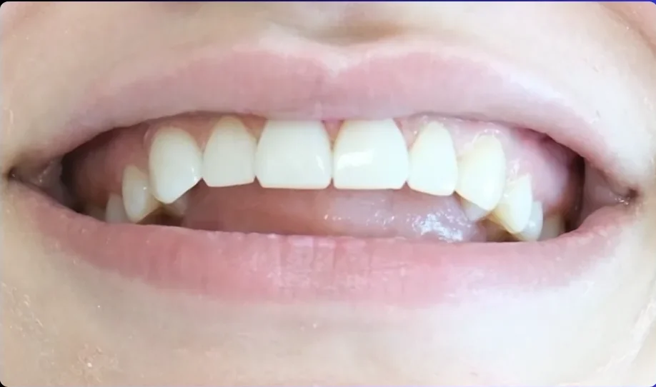 Composite bonding after photo, upper front teeth, case 20