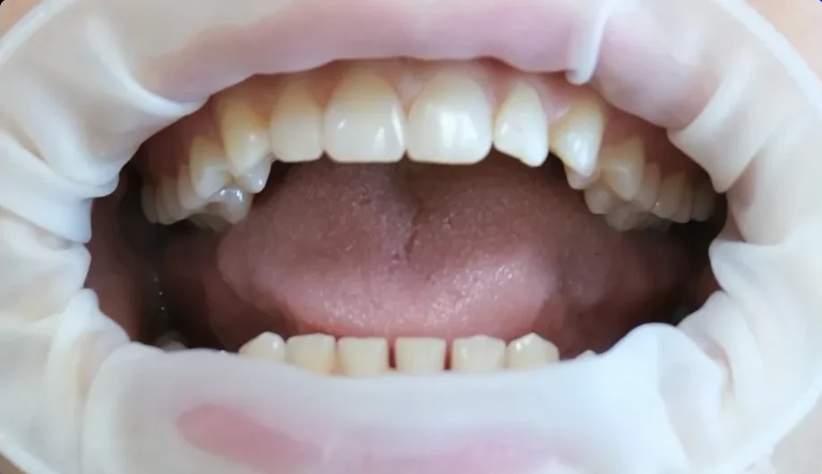 Composite bonding before photo, upper front teeth, case 20