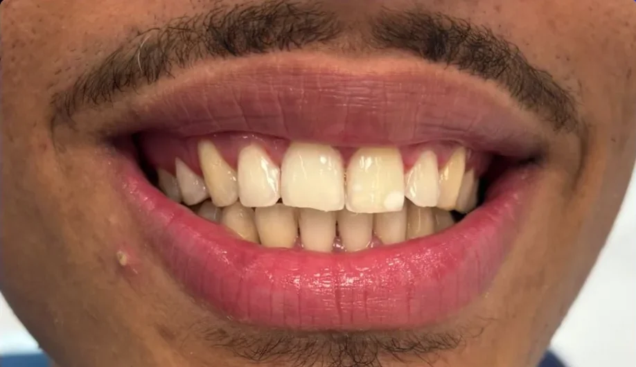 Composite bonding before photo, upper front teeth, case 21