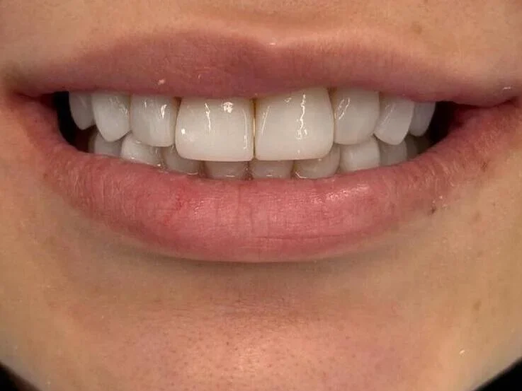Composite bonding after photo, upper front teeth, case 2