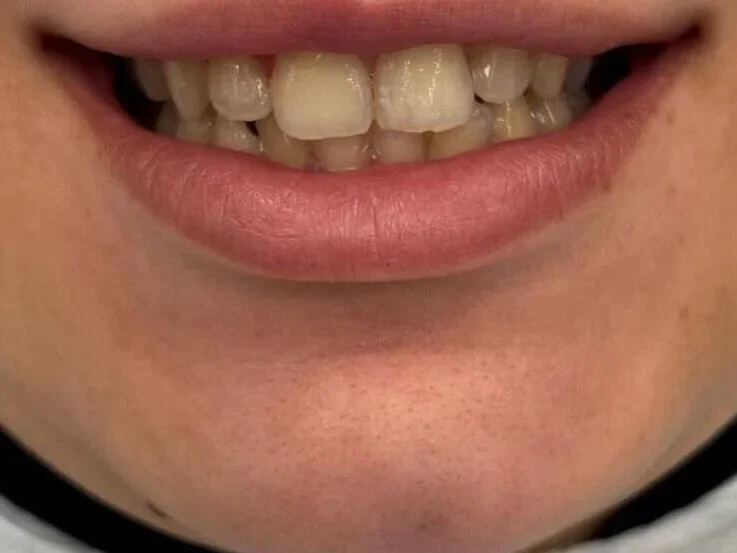 Composite bonding before photo, upper front teeth, case 2