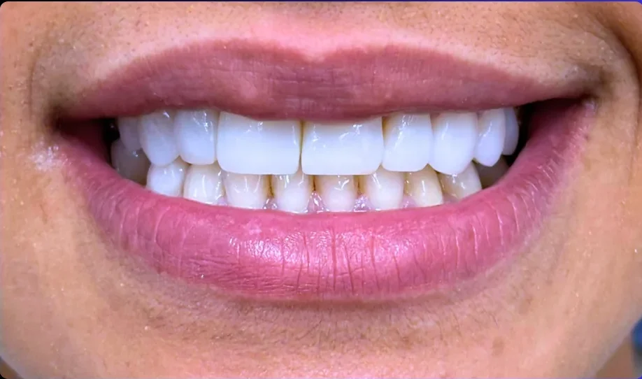 Composite bonding after photo, upper front teeth, case 3