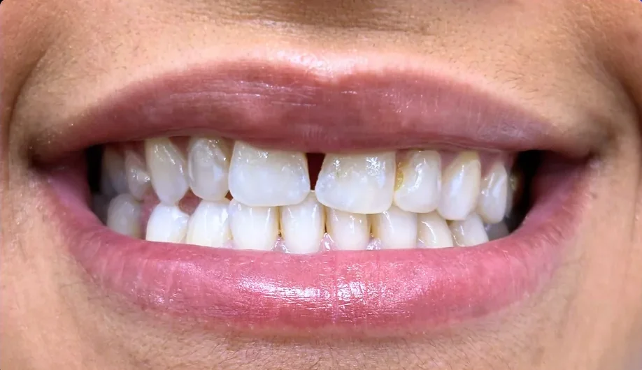 Composite bonding before photo, upper front teeth, case 3