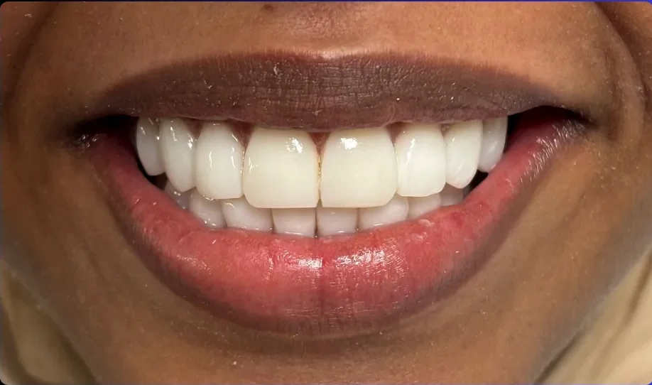 Composite bonding after photo, upper front teeth, case 4
