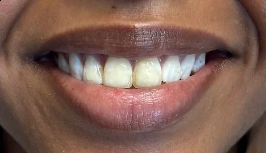 Composite bonding before photo, upper front teeth, case 4