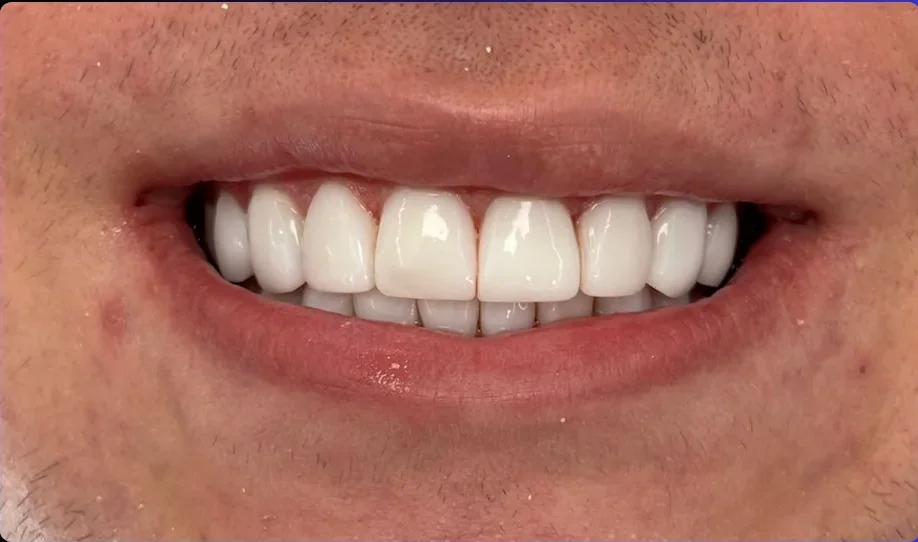 Composite bonding after photo, upper front teeth, case 5