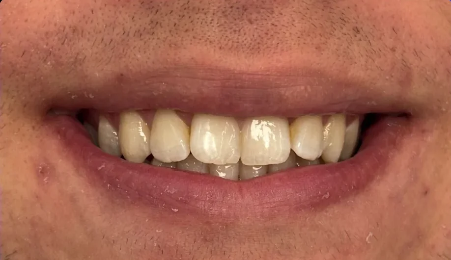 Composite bonding before photo, upper front teeth, case 5