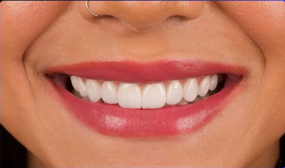 Composite bonding after photo, upper front teeth, case 6