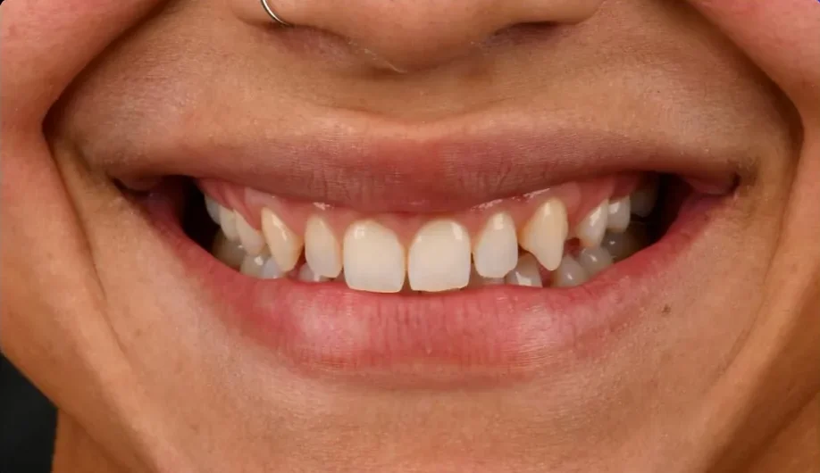 Composite bonding before photo, upper front teeth, case 6