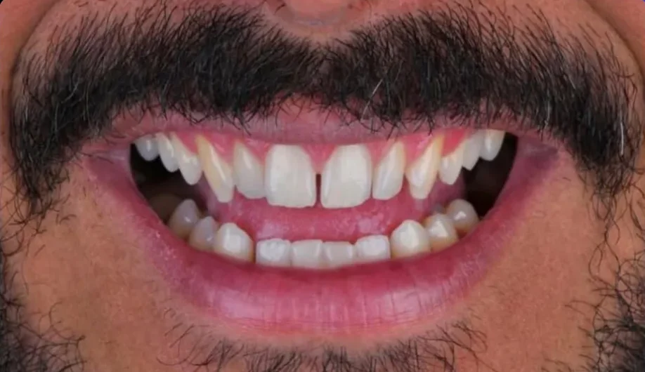 Composite bonding before photo, upper front teeth, case 7