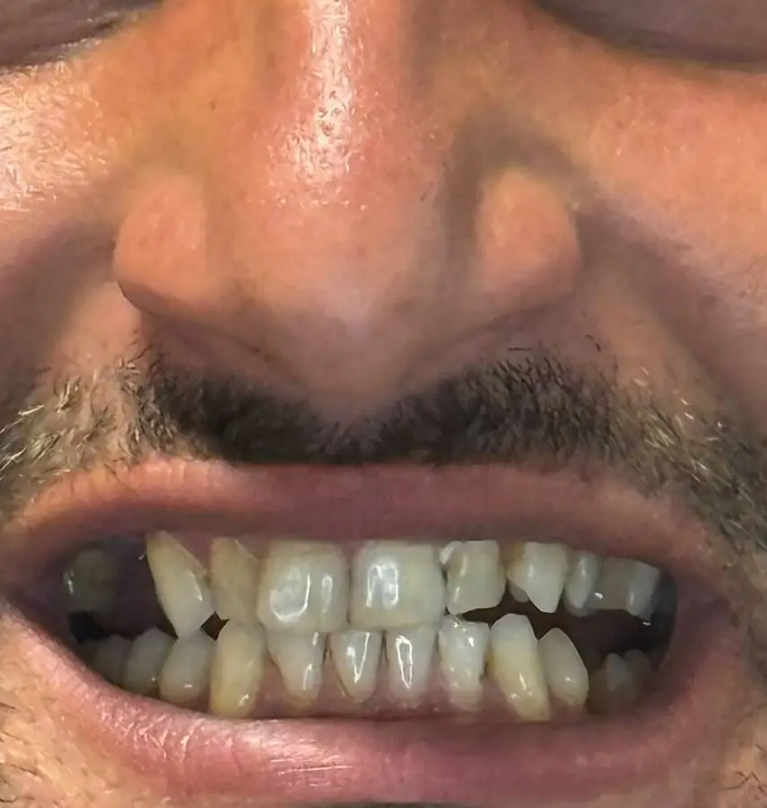 E.max crown case before treatment, front teeth, DentVisit patient