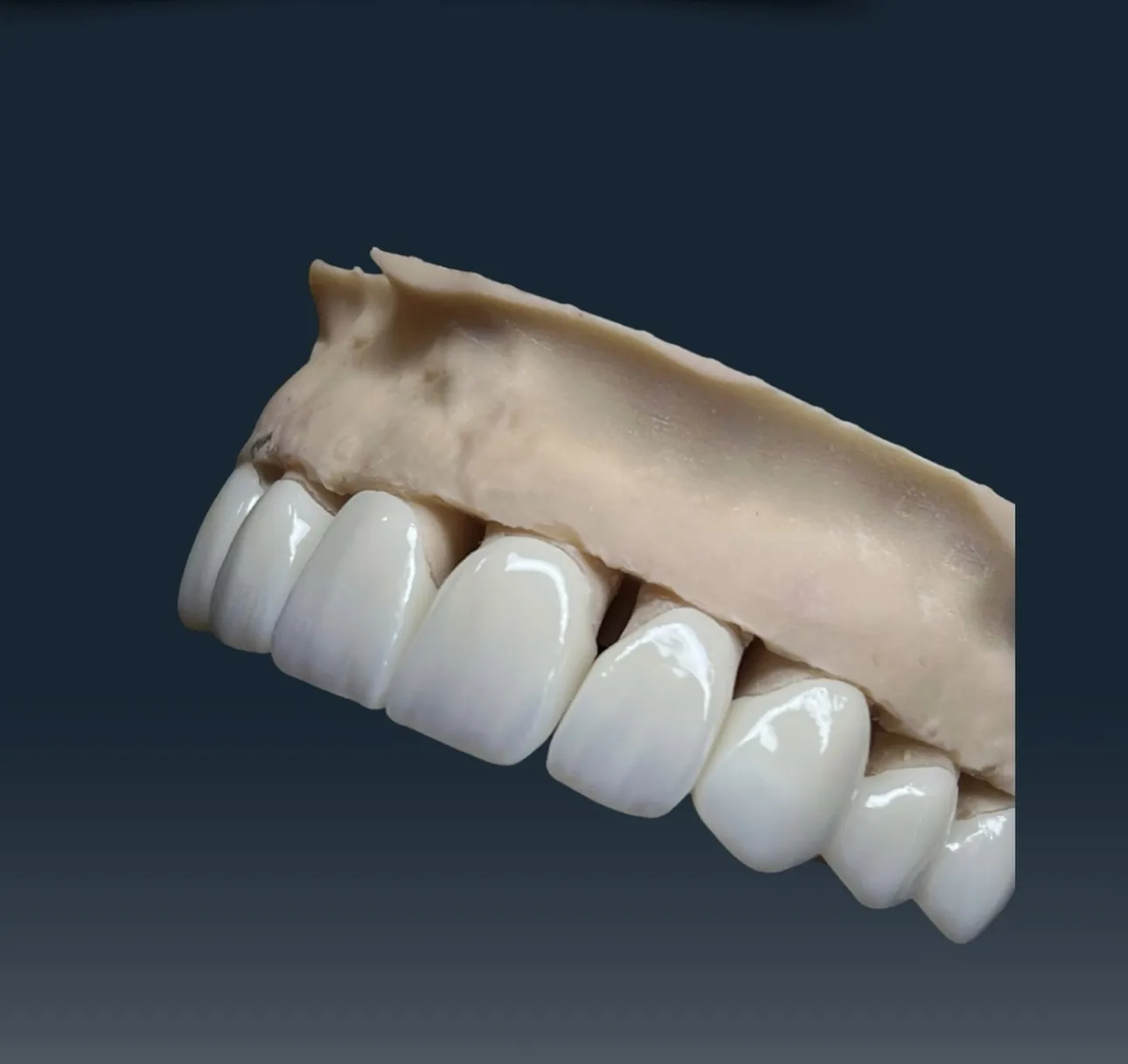 DentVisit — anterior crown, layering detail on a plaster model