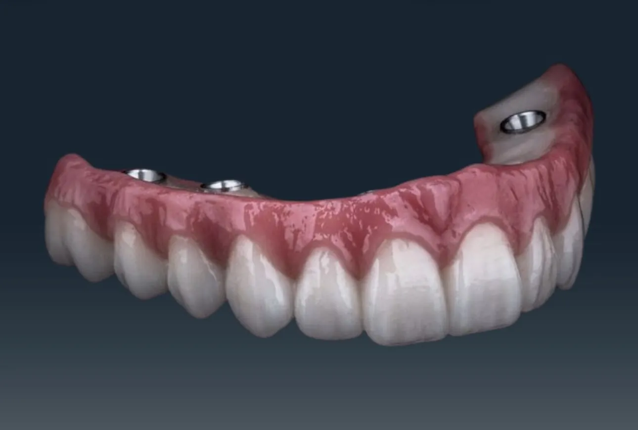 DentVisit — full-arch prosthesis, gingival aesthetic detail
