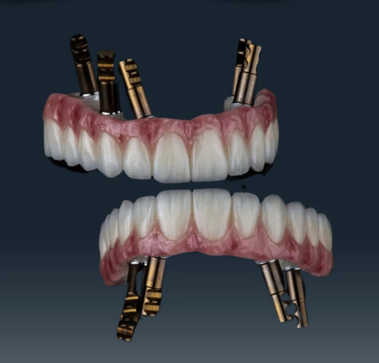DentVisit — upper and lower full-arch implant prosthesis