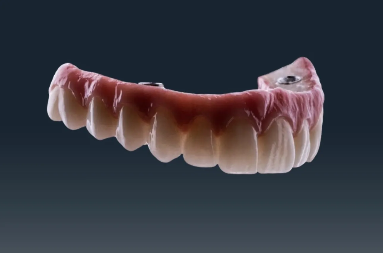 DentVisit — full-arch prosthesis, screw channel detail